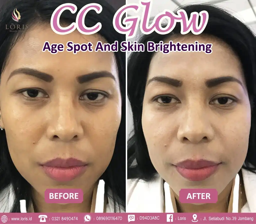 CC GLOW : Age Spot And Skin Brightening - Loris Beauty Clinic