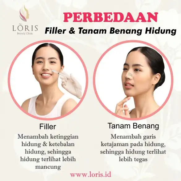 PERBEDAAN FILLER HIDUNG DAN TANAM BENANG HIDUNG - Loris Beauty Clinic